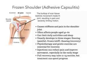 Frozen Shoulder Therapy in Eastleigh and Southampton