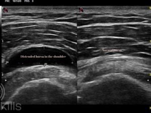 shoulder bursitis in the shoulder