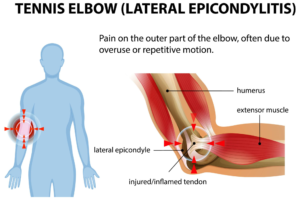image showing lateral elbow affected in tennis elbow